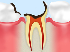C4：歯根にまでおよんだ虫歯